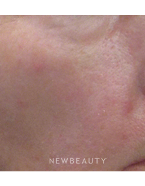 Dr. Kally Papantoniou - Laser Resurfacing - After