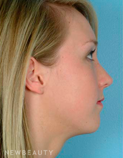 Dr. David Kim Rhinoplasty - After