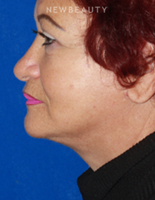 Dr. Konstantin Vasyukevich - Lower Facelift - After