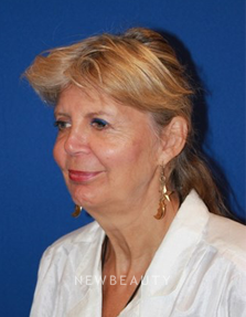 Dr. Dilip Madnani - Facelift - Before