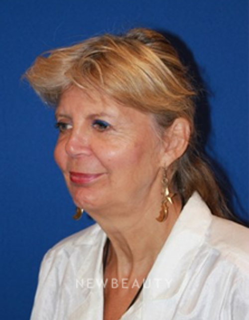 Dr. Dilip Madnani - Facelift - Before