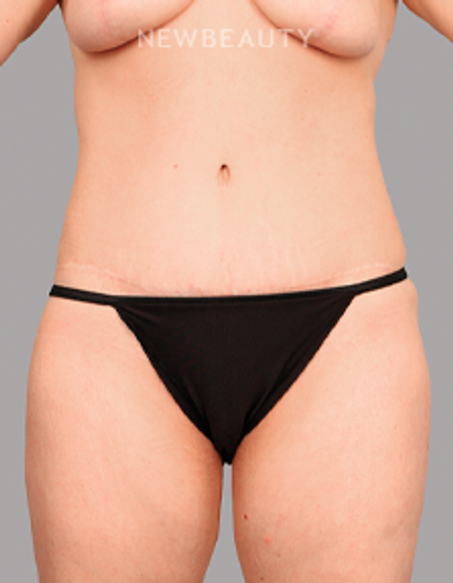 Dr. Chet Mays - Body Sculpting and Tummy Tuck - 35067825 - After