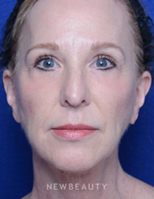 Dr. Alan Durkin - Facelift - After