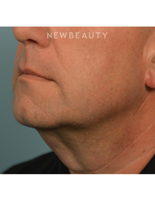 Dr. Ruth Hillelson - Tighter and Firmer - After