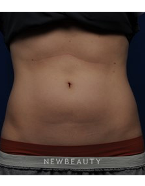 Dr. Gilly Munavalli - UltraShape - After