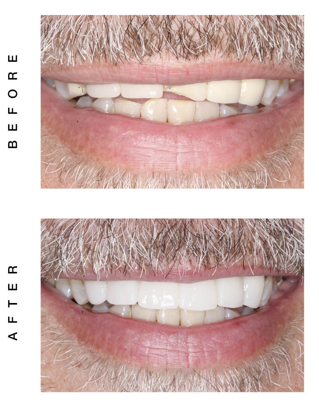 ceramic bridge before and after