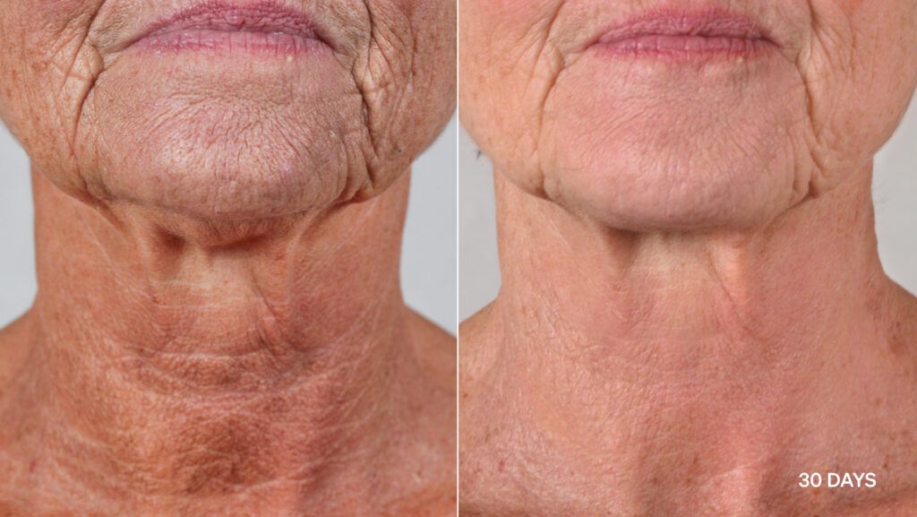 lyma laser pro results