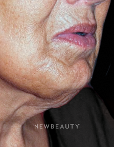 Dr. Roman Rayham - Facelift - Before