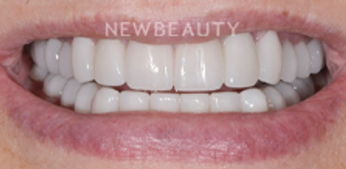 Dr. Salvator La Mastra - Smile Makeover -46107752 - After