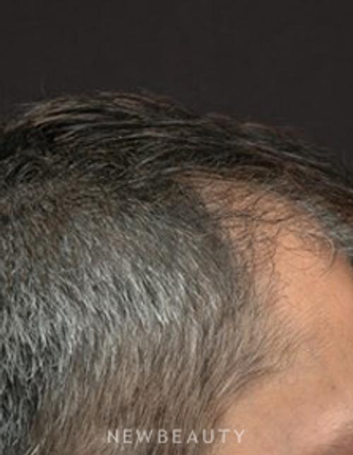 Dr. Jeffrey B. Wise - Hair Transplant - Before