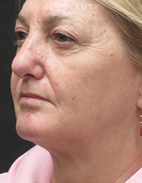 Dr. Elie Levine - Necklift & Rhinoplasty - After