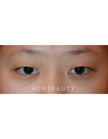 Dr. John Kang - Eyelift - Before