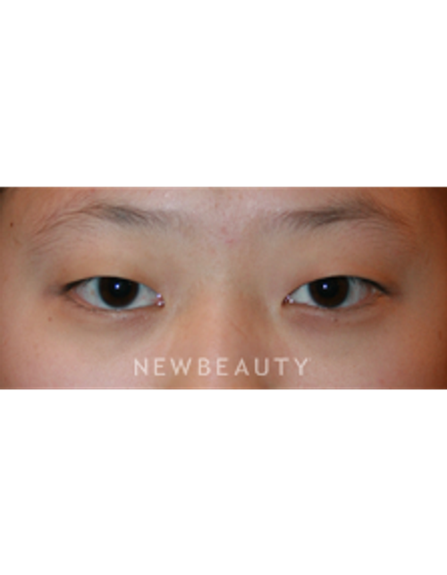 Dr. John Kang - Eyelift - Before