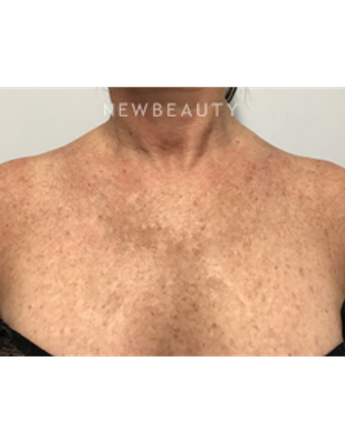 Dr. Marina Peredo - Skinfluence “Trinity Treatment” - Before