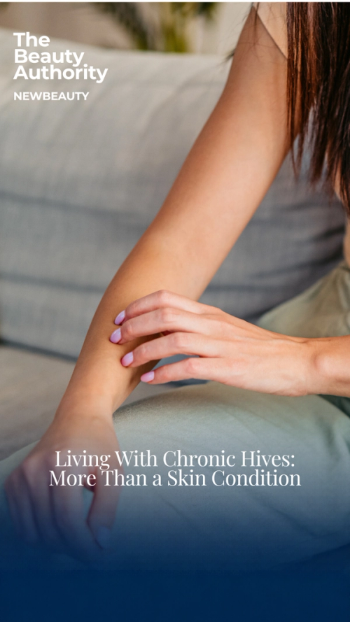 Living With Chronic Hives: One Patient’s Story