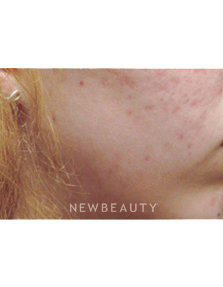Dr. Jody Levine Lasers - Before