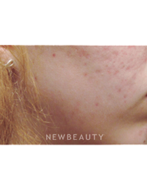 Dr. Jody Levine Lasers - Before
