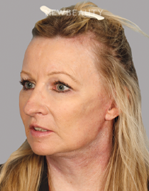 Dr. Mahabir - Facelift - 20637984 - After