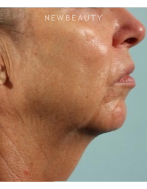 Dr. Marina Peredo - Firmatherapy for Sagging Skin - Before