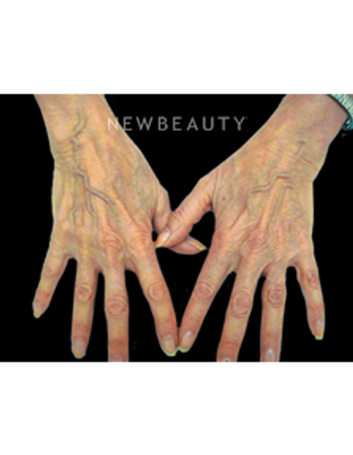 Dr. Doris Day - Reducing Wrinkles - Before