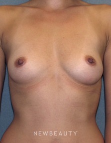 Dr Sean Simon Breast Augmentation - Before