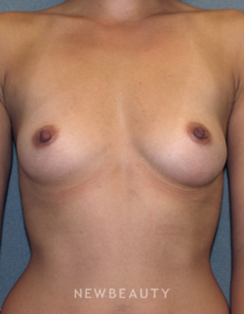 Dr Sean Simon Breast Augmentation - Before
