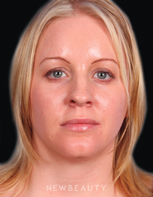 Dr. Kelly Bomer Injectables & Fillers - After