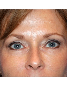Dr. Kelly Bomer Liquid Facelift - After