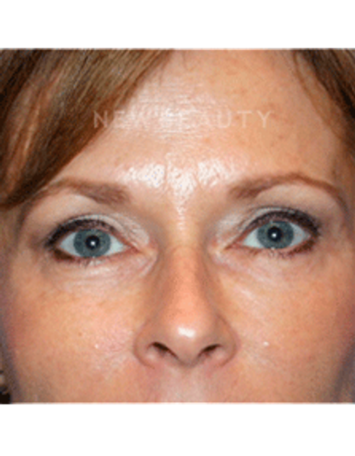 Dr. Kelly Bomer Liquid Facelift - After
