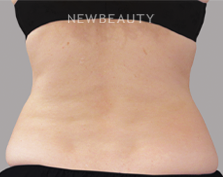 Dr. Lily Lee - CoolSculpting - After