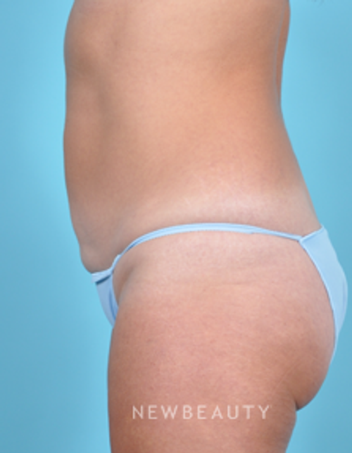 Dr. Bradley Bengtson - CoolSculpting - After