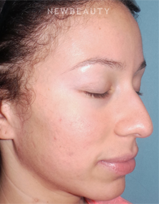 Dr. Sean Simon - Fresh and Clear Skin - After