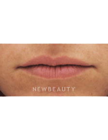 Dr Kenneth Beer Lip Augmention - Before