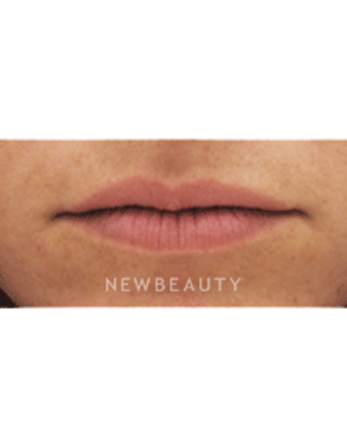 Dr Kenneth Beer Lip Augmention - Before
