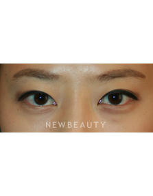 Dr. John Kang - Eyelift - After