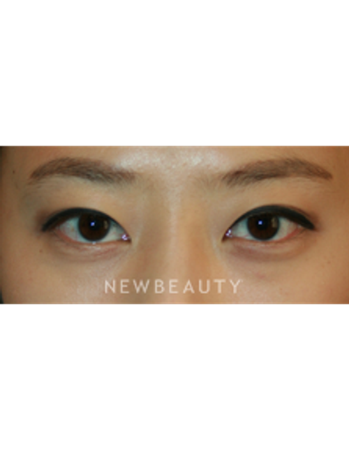 Dr. John Kang - Eyelift - After