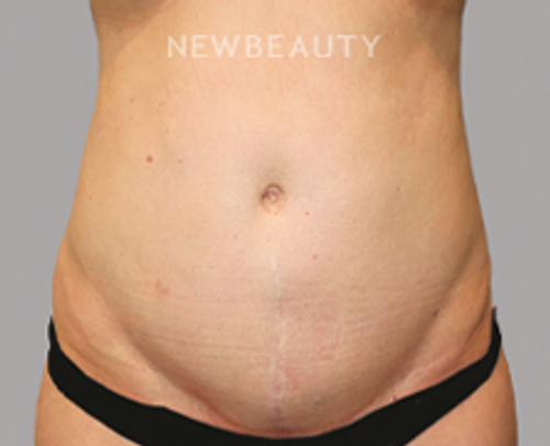 Dr. Sanjay Grover - Liposuction - 49728036 - Before
