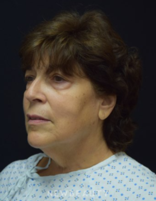 Dr. Jeffrey B. Wise - Deep Plane Facelift - Before