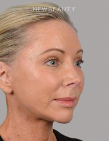 Dr. Henry A. Mentz - Full-Face Rejuvenation - After
