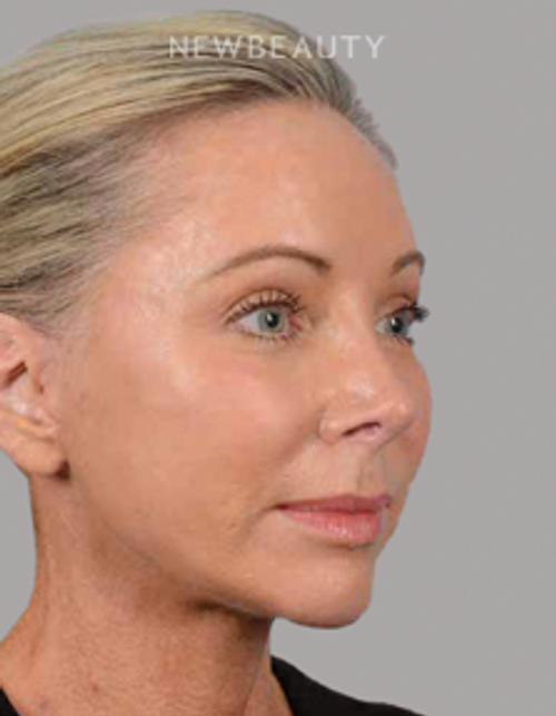 Dr. Henry A. Mentz - Full-Face Rejuvenation - After