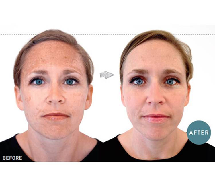Spot-Free Skin