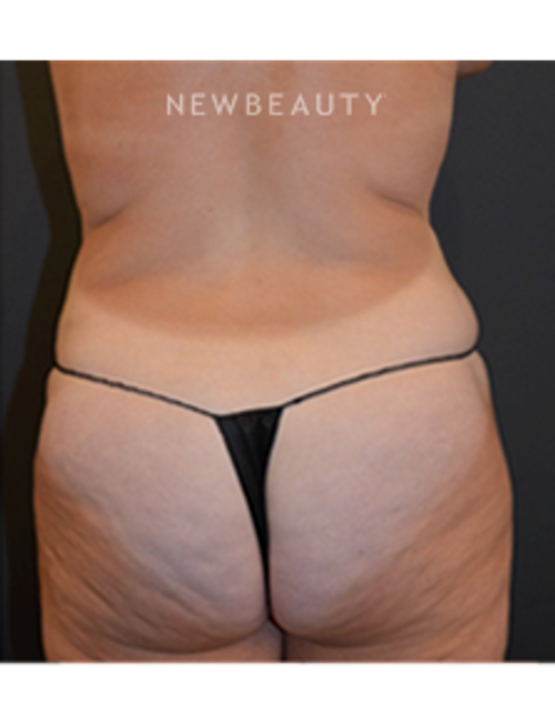 Dr. Aviva Preminger - CoolSculpting - After