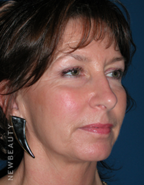 Dr. Adam Summers Chin Liposuction, Smart Facelift - After