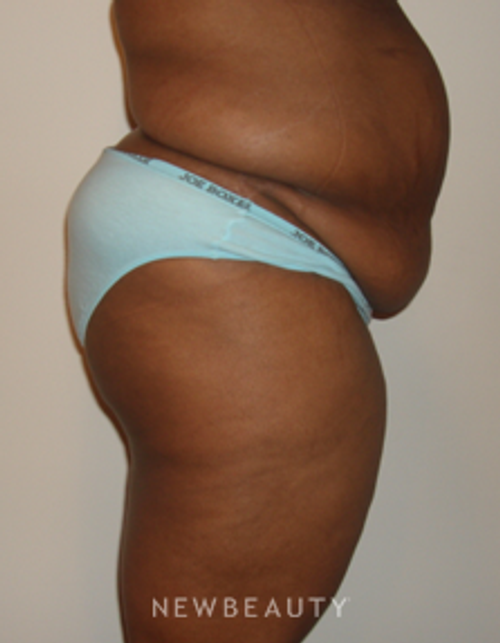 Dr. Michael Horn Tummy Tuck, Liposuction - Before