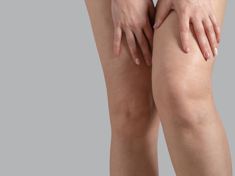 3 Ways to Permanently Get Rid of Visible Veins Anywhere on the Body