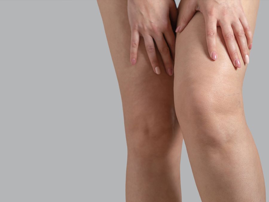 3 Ways to Permanently Get Rid of Visible Veins Anywhere on the Body