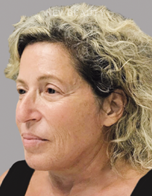 Dr. Janet Allenby - “Liquid Facelift” - Before