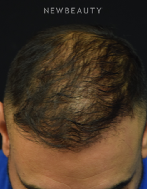 Dr. Jeffrey B. Wise - Hair Transplant for Hair Loss - After