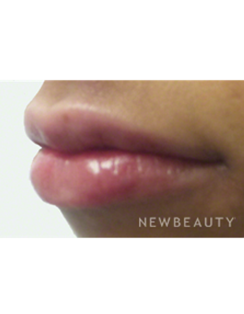Dr. Kally Papantoniou - Volumizing Lips - After