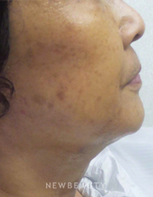 Dr. Kally Papantoniou - Ulthera - Before